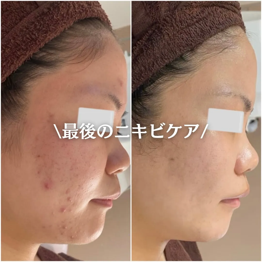 太田市にある頑固なニキビ専門店です✨️