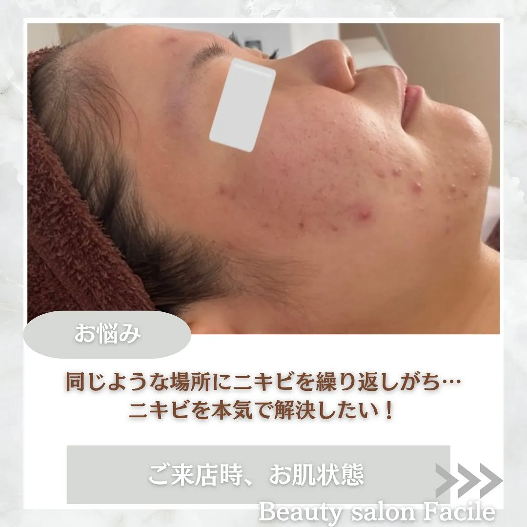 太田市にある頑固なニキビ専門店です✨️
