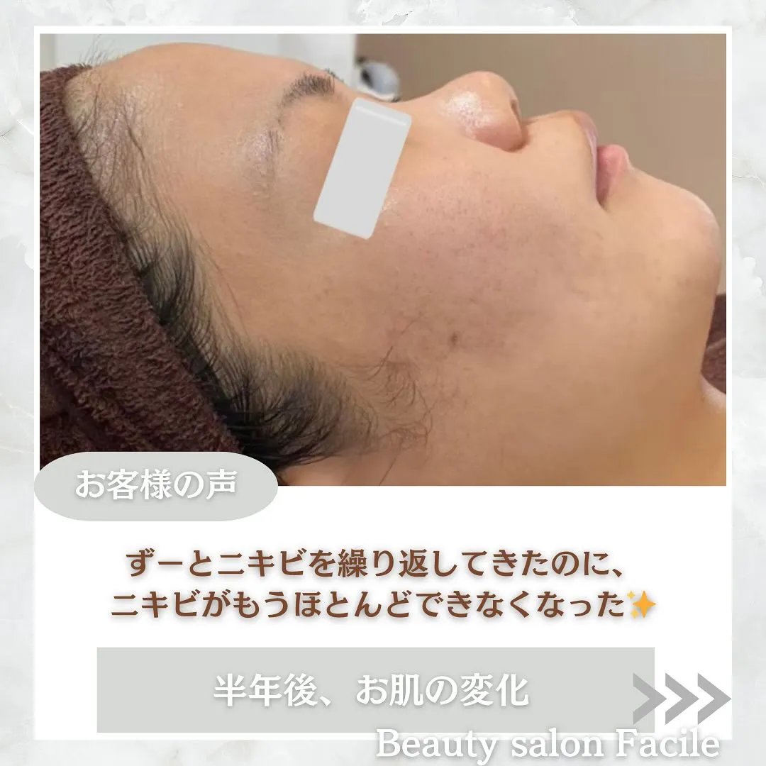 太田市にある頑固なニキビ専門店です✨️