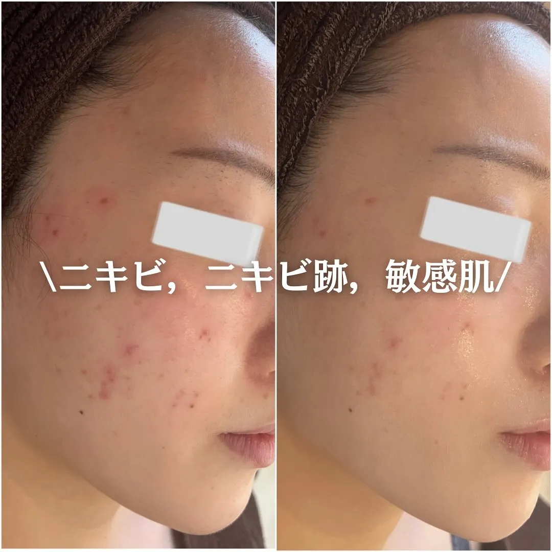 太田市にある頑固なニキビ専門店です✨️