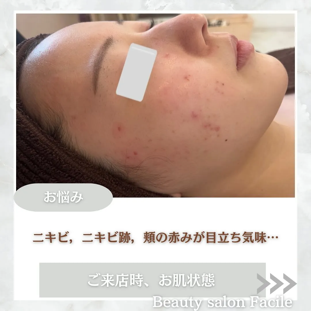 太田市にある頑固なニキビ専門店です✨️