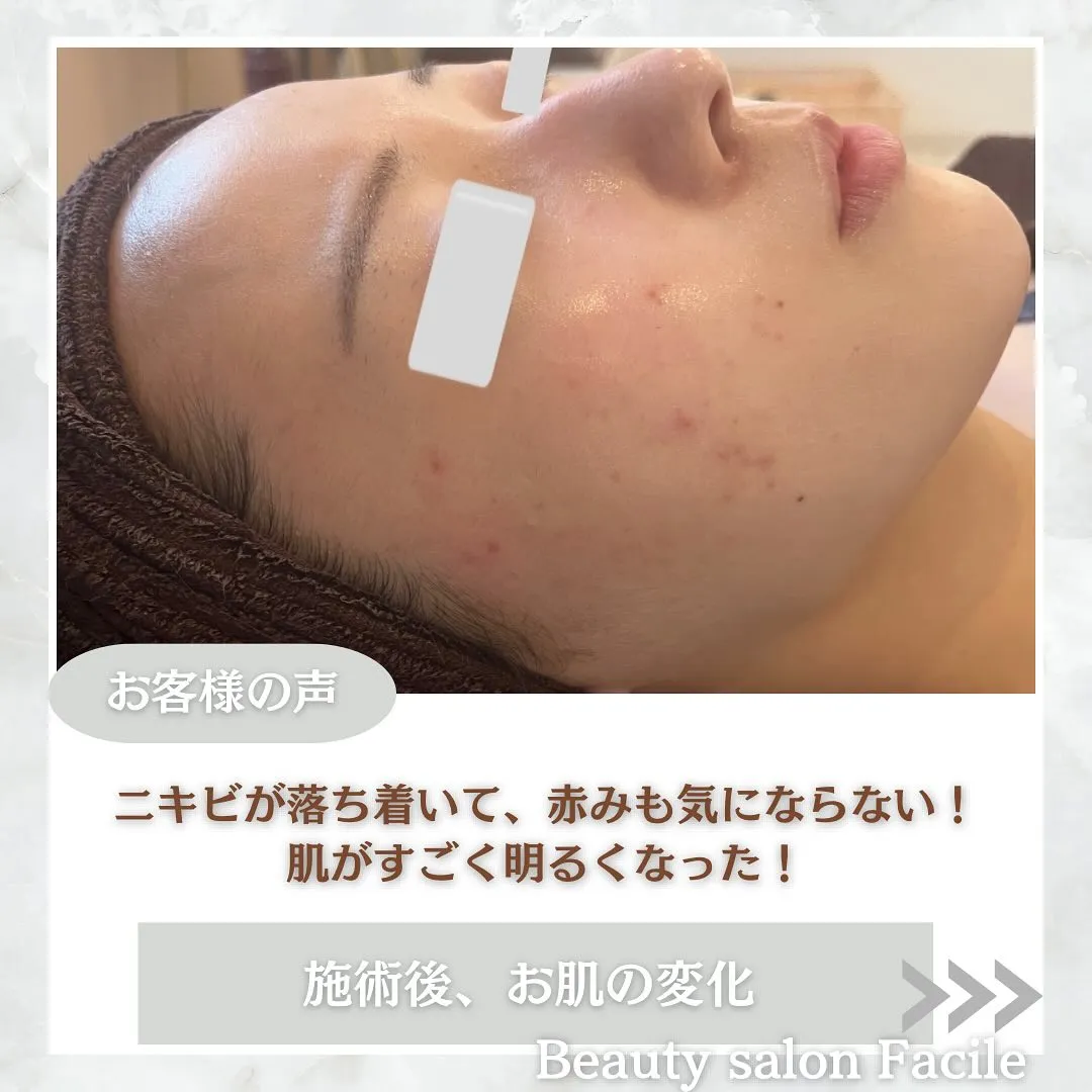 太田市にある頑固なニキビ専門店です✨️