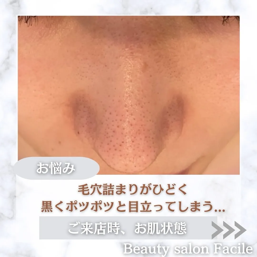 太田市にある頑固なニキビ専門店です✨️