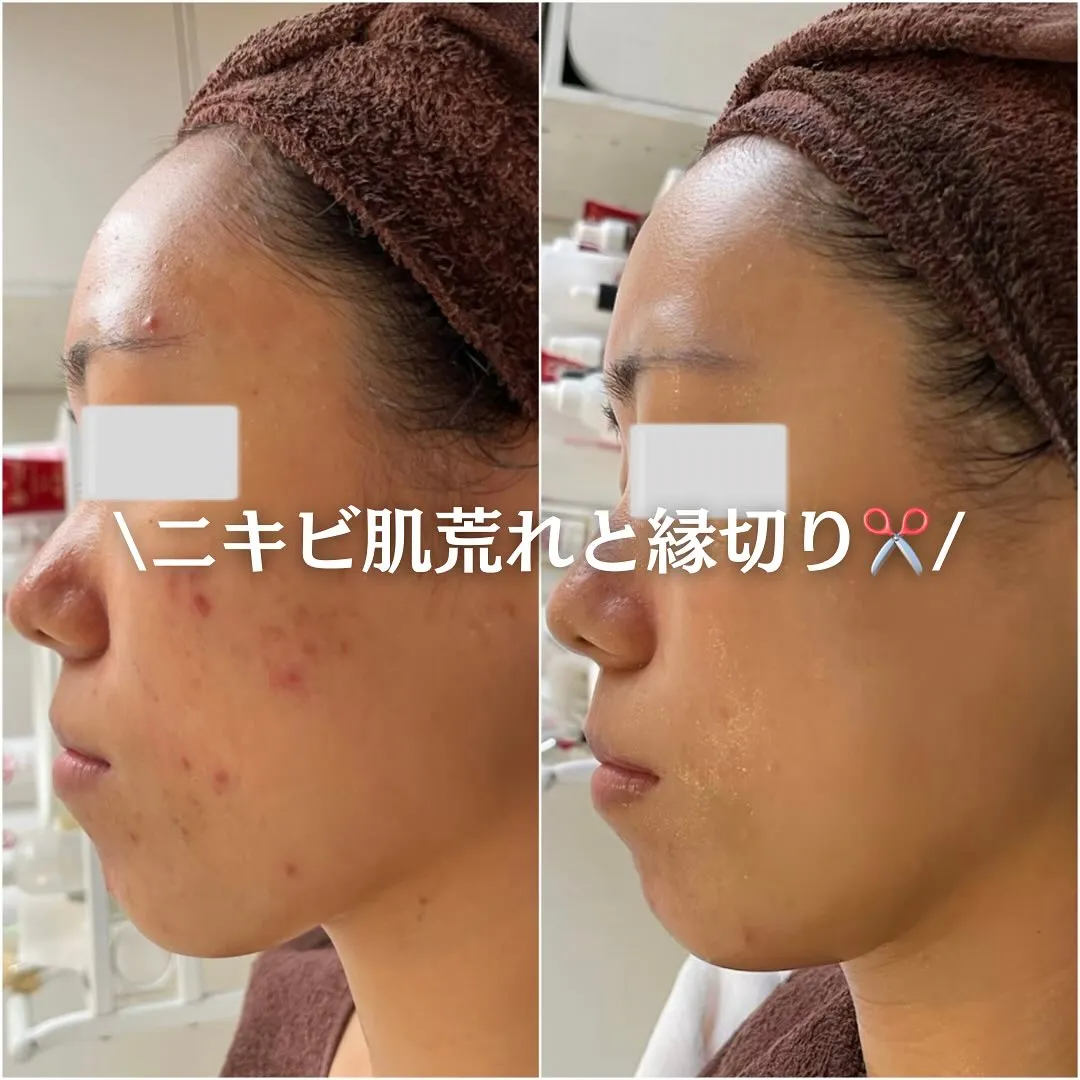 太田市にある頑固なニキビ専門店です✨️