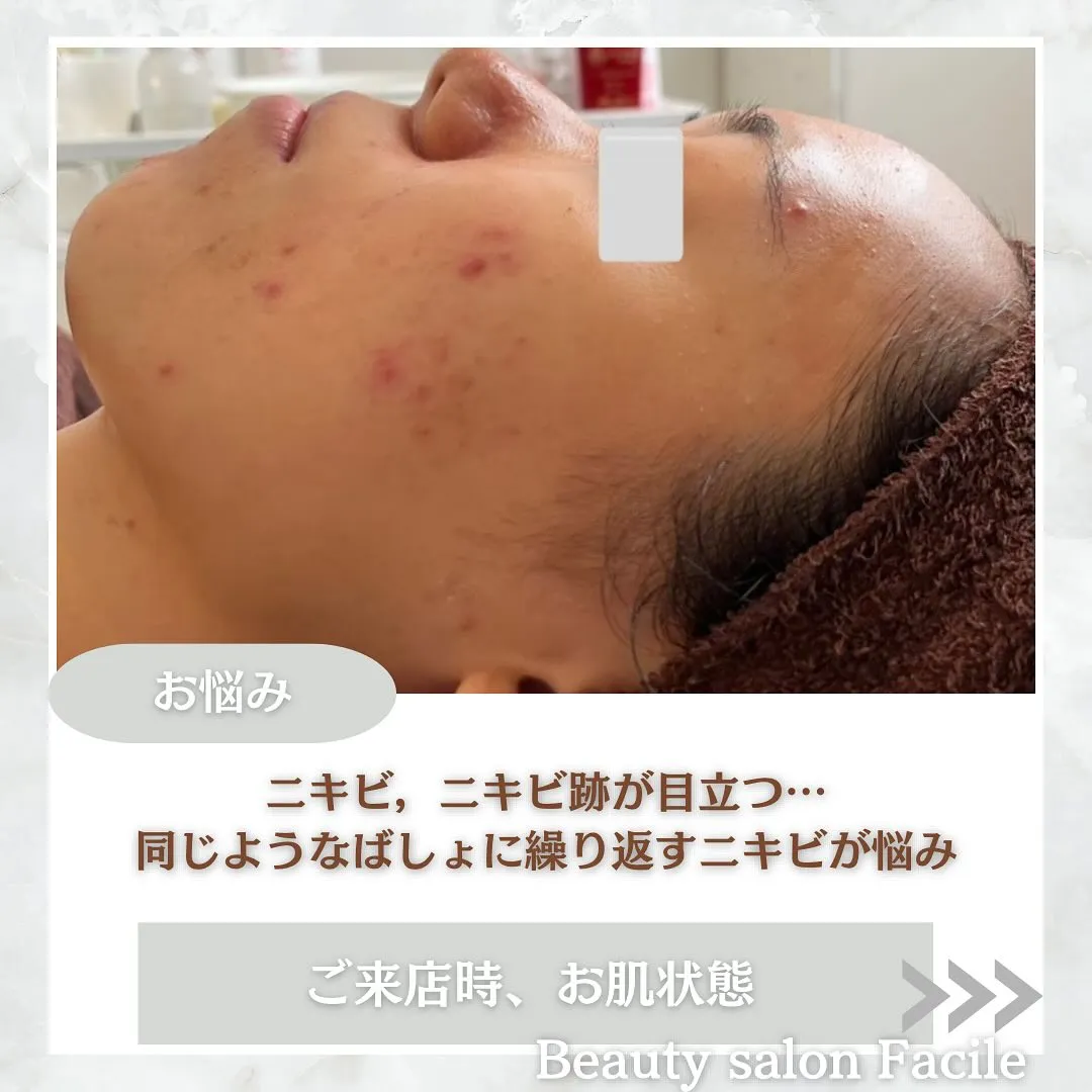 太田市にある頑固なニキビ専門店です✨️