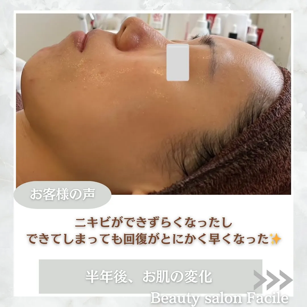 太田市にある頑固なニキビ専門店です✨️