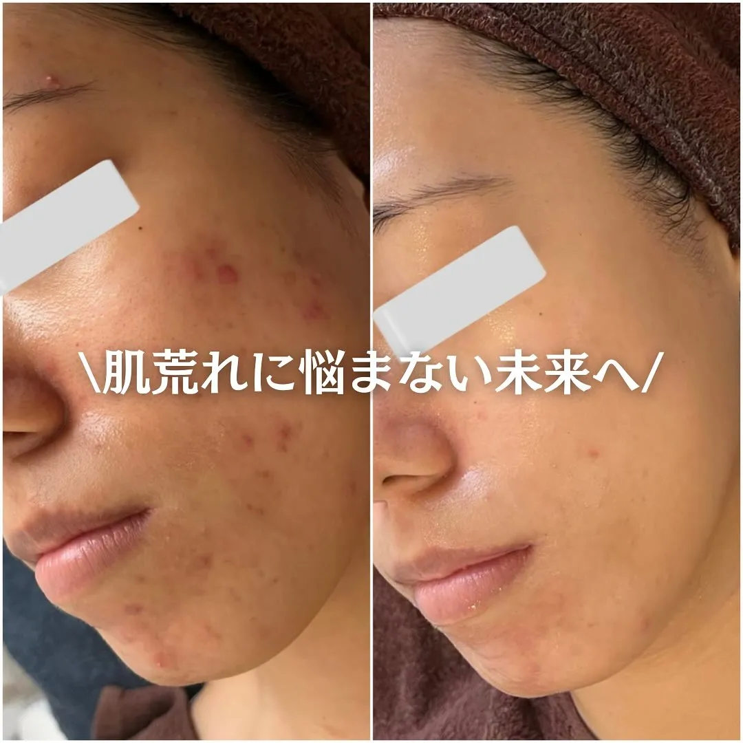 太田市にある頑固なニキビ専門店です✨️