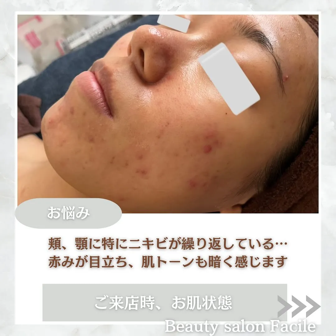 太田市にある頑固なニキビ専門店です✨️