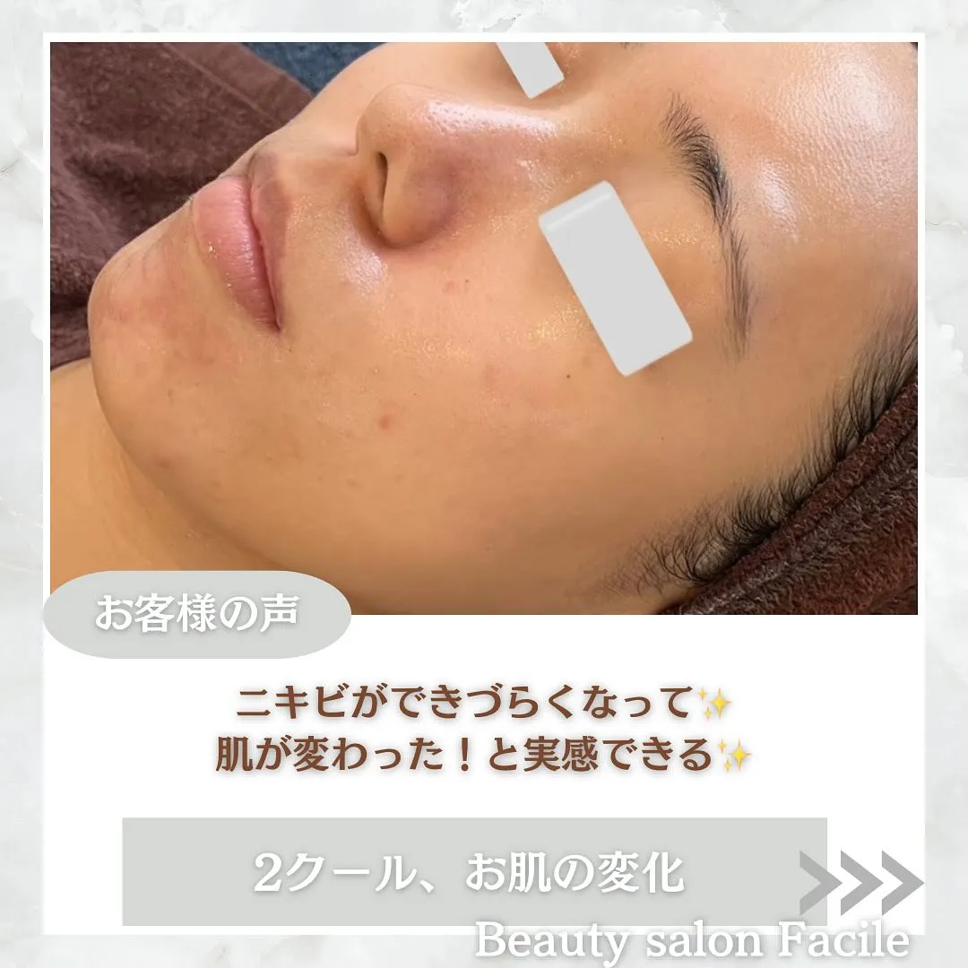 太田市にある頑固なニキビ専門店です✨️