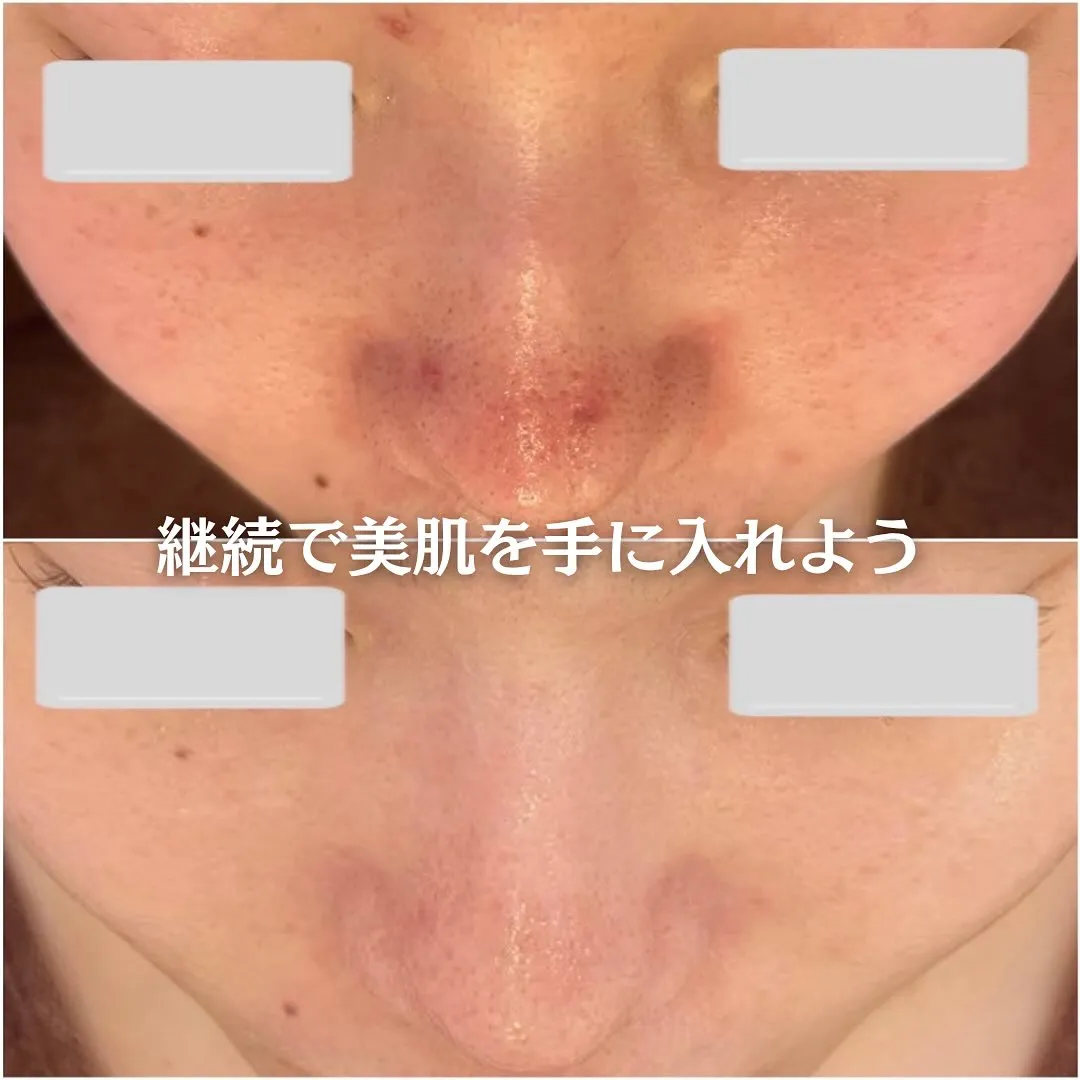 太田市にある頑固なニキビ専門店です✨️