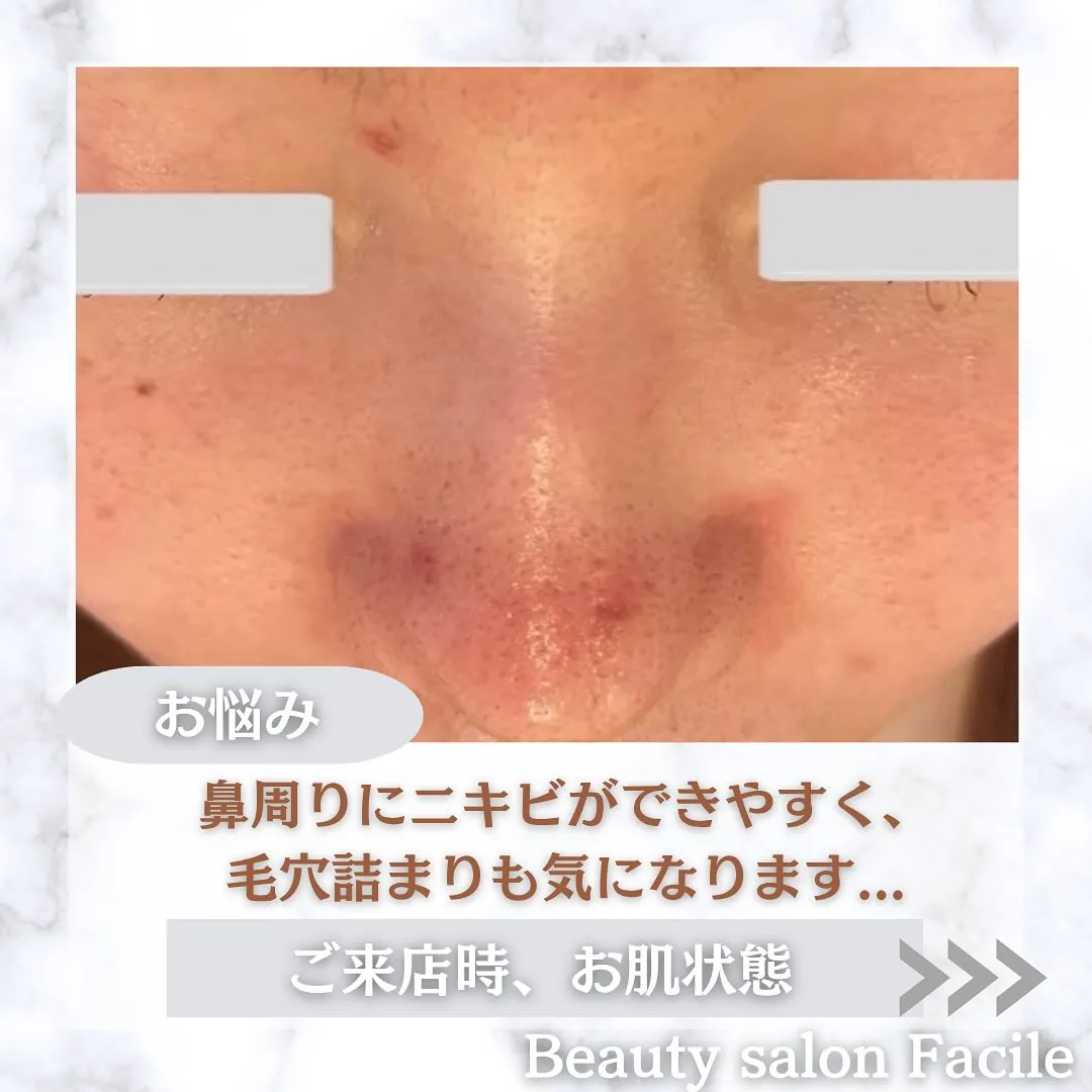 太田市にある頑固なニキビ専門店です✨️