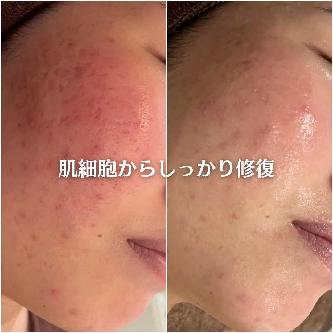 太田市にある頑固なニキビ専門店です✨️