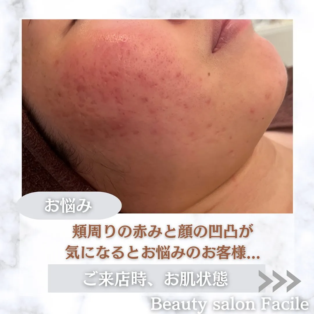 太田市にある頑固なニキビ専門店です✨️