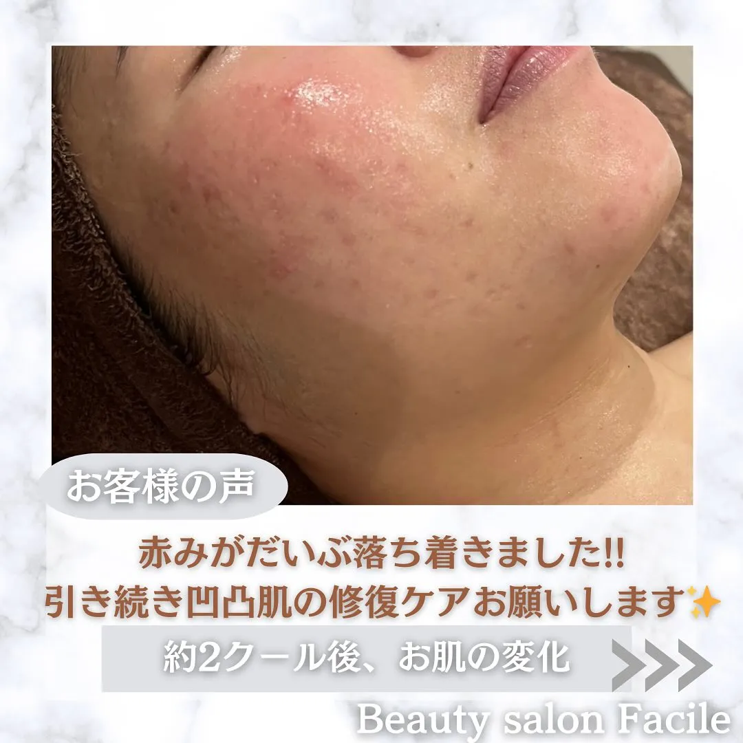 太田市にある頑固なニキビ専門店です✨️