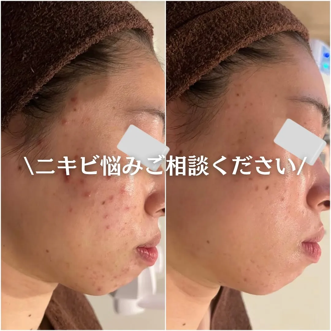 太田市にある頑固なニキビ専門店です✨️