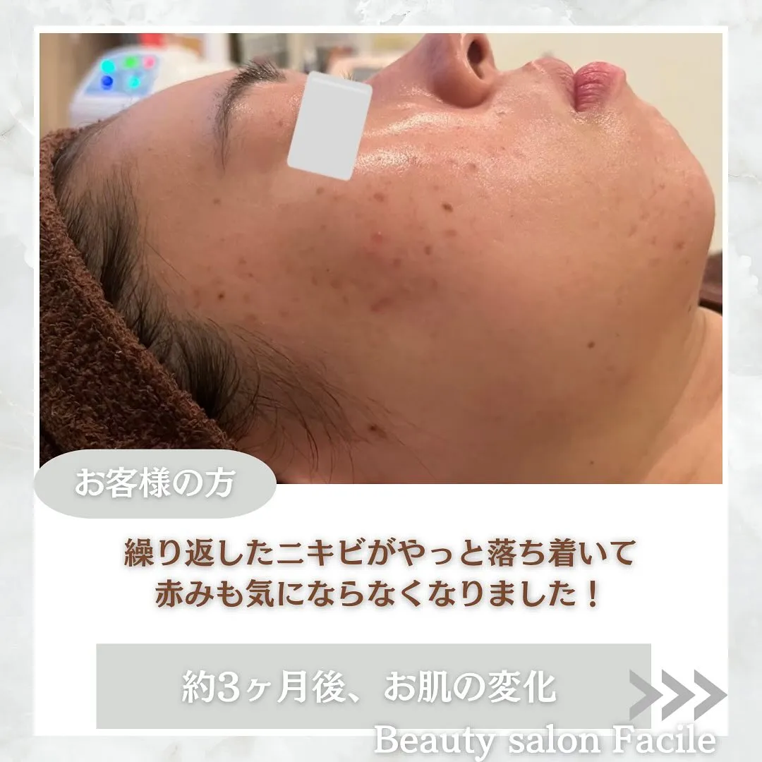 太田市にある頑固なニキビ専門店です✨️