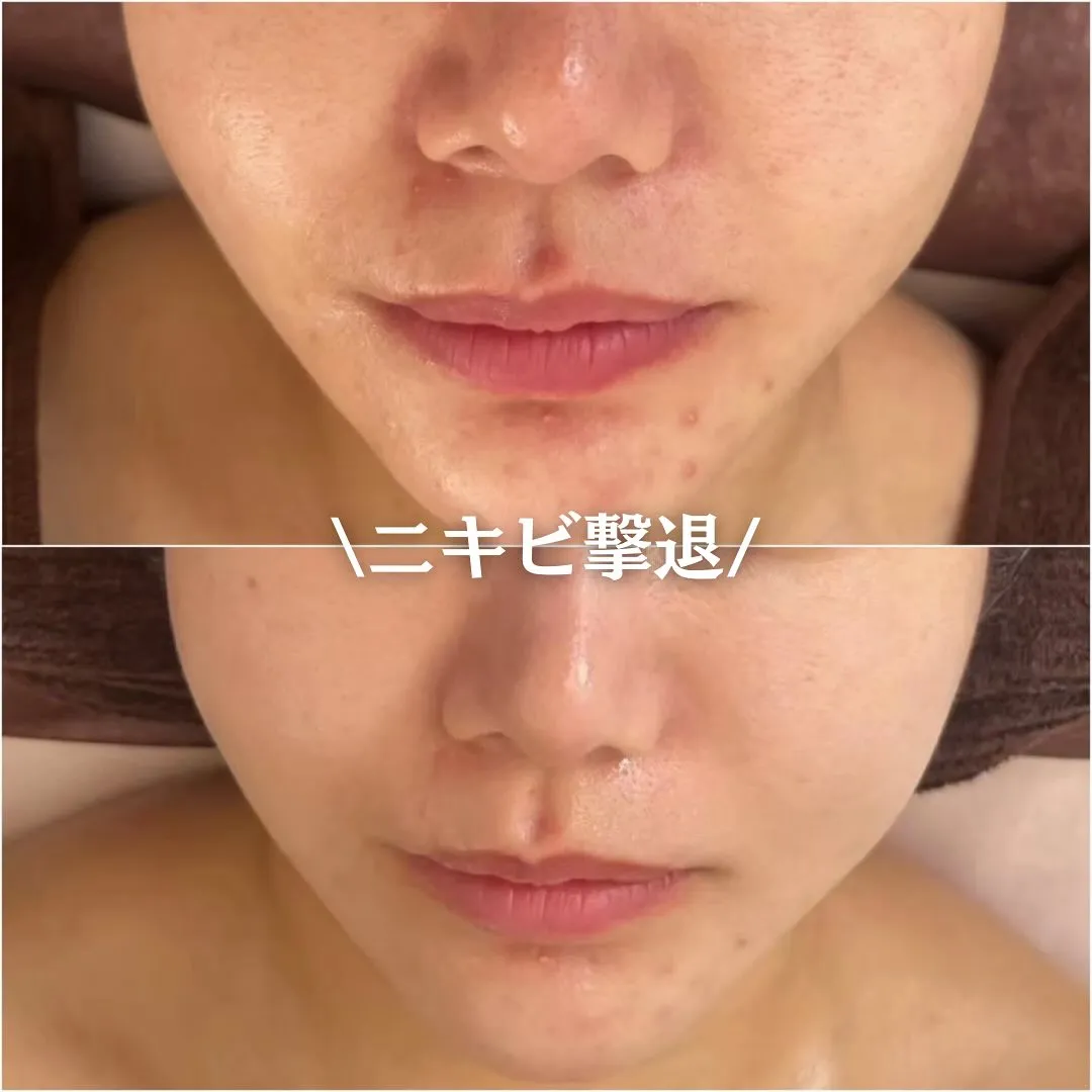太田市にある頑固なニキビ専門店です✨️