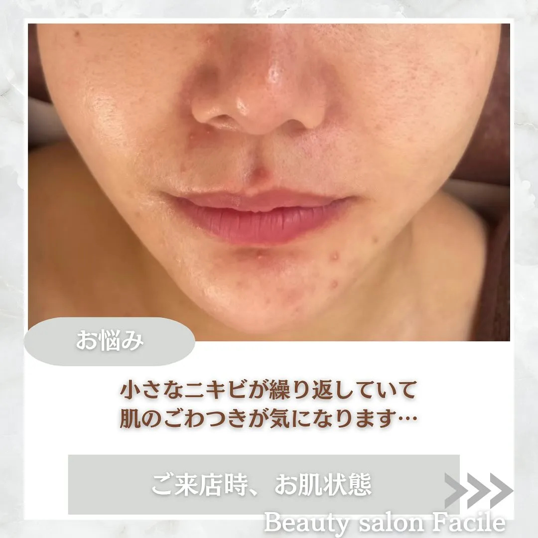 太田市にある頑固なニキビ専門店です✨️