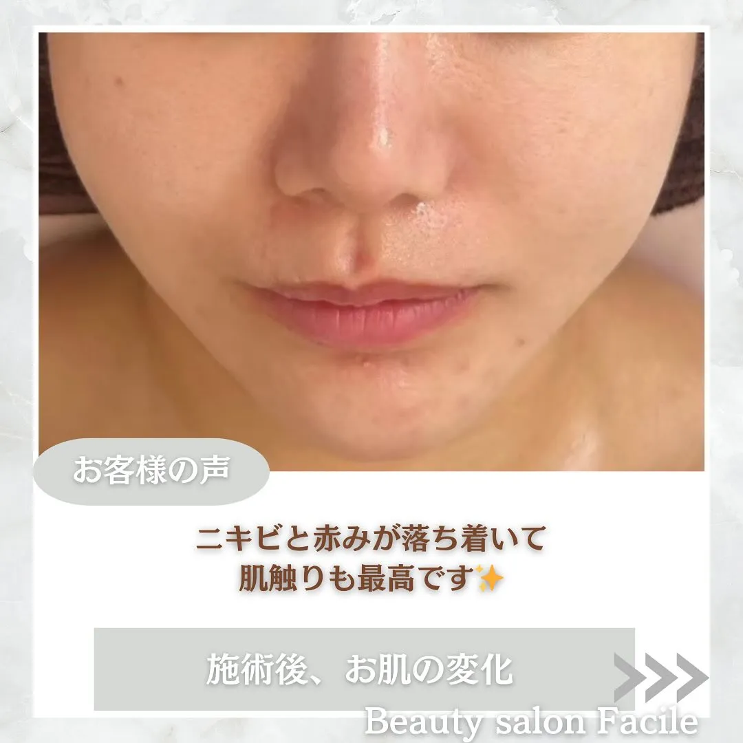 太田市にある頑固なニキビ専門店です✨️