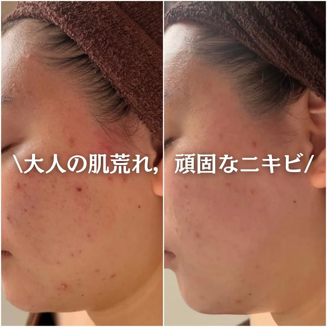 太田市にある頑固なニキビ専門店です✨️