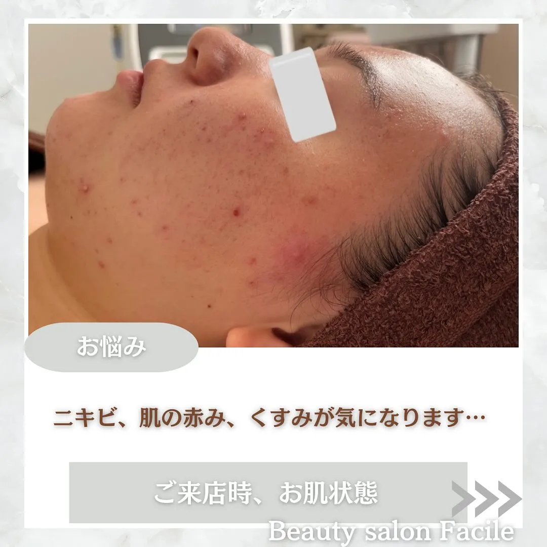 太田市にある頑固なニキビ専門店です✨️