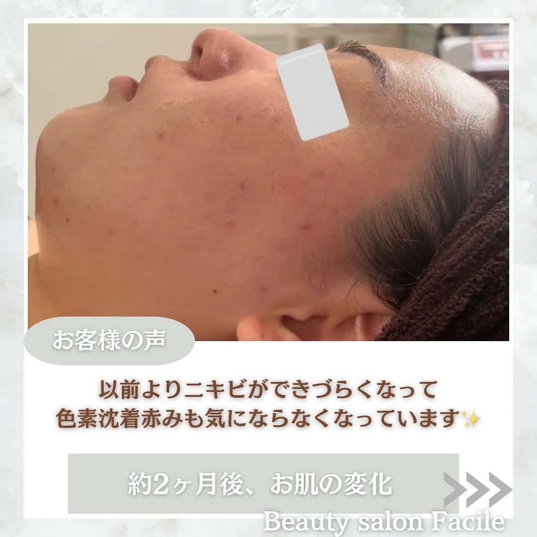 太田市にある頑固なニキビ専門店です✨️