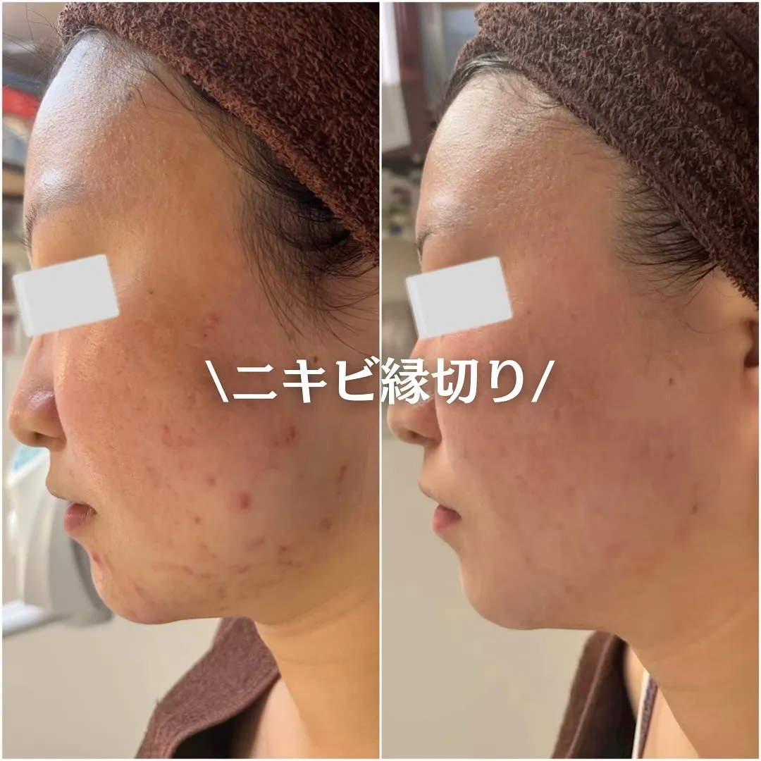 太田市にある頑固なニキビ専門店です✨️