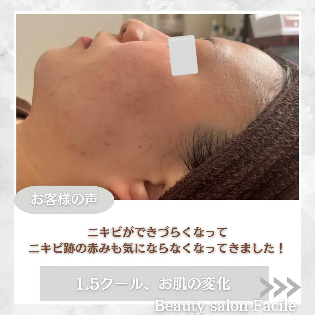 太田市にある頑固なニキビ専門店です✨️