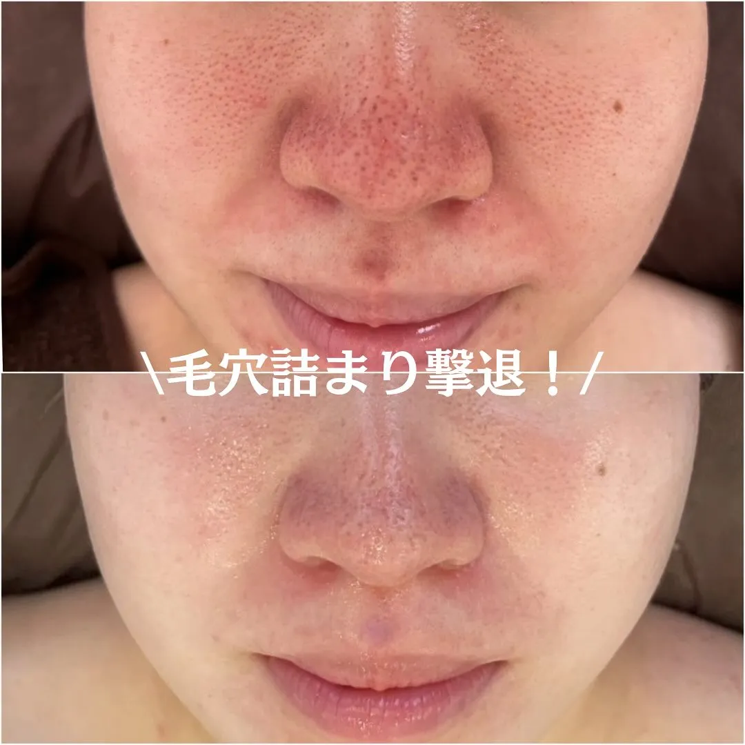 太田市にある頑固なニキビ専門店です✨️