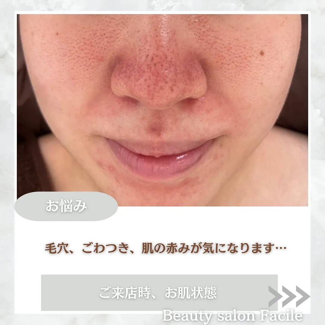 太田市にある頑固なニキビ専門店です✨️