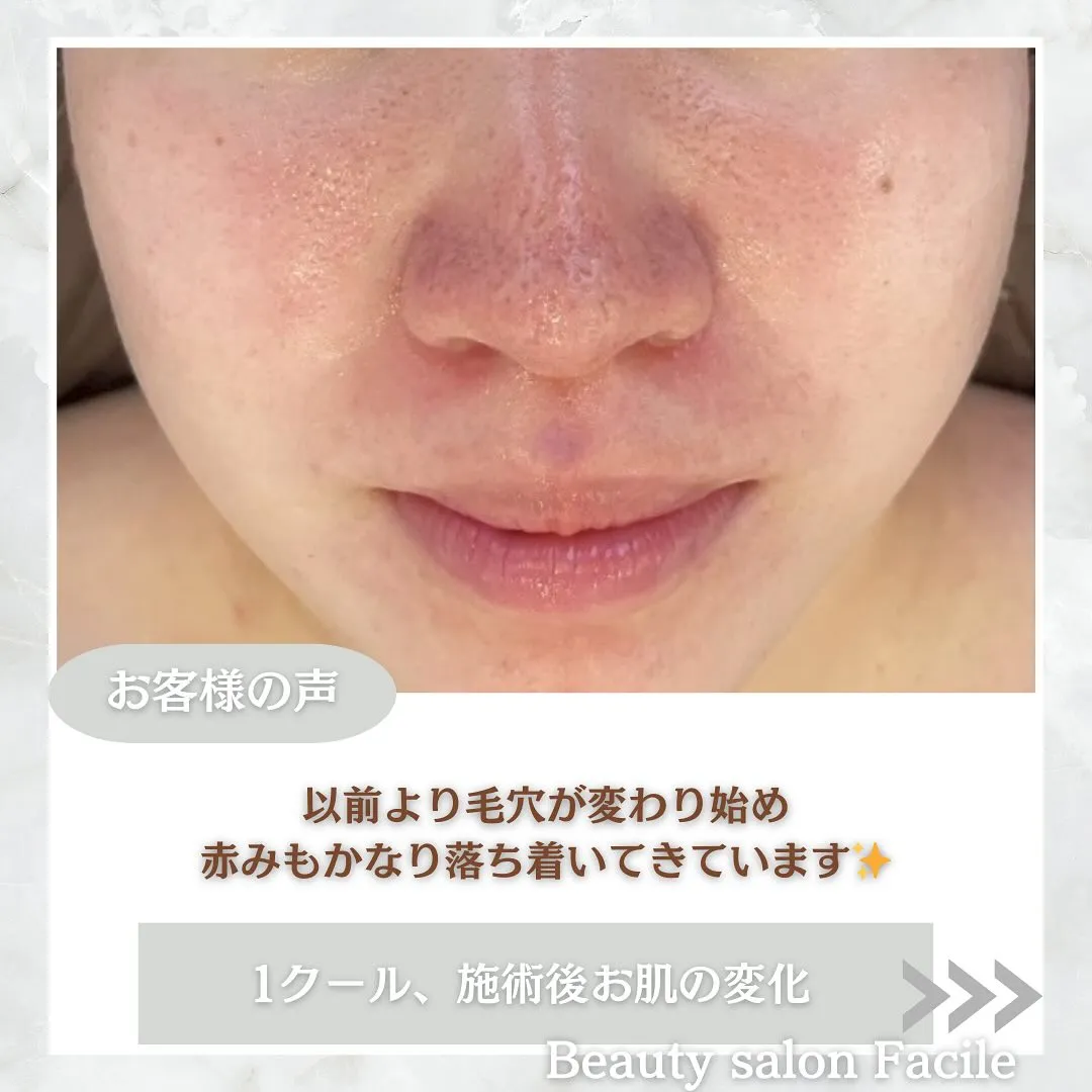 太田市にある頑固なニキビ専門店です✨️