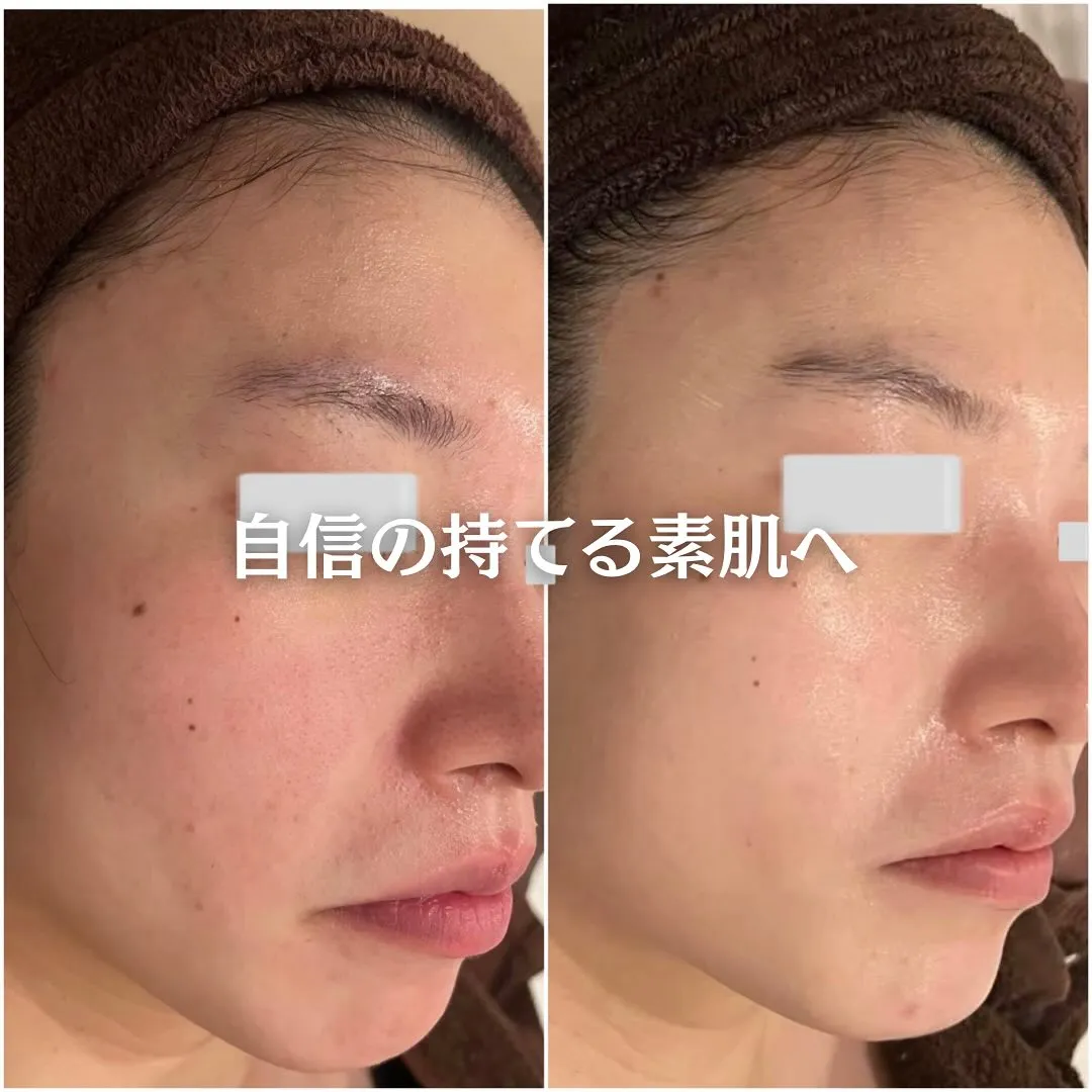 太田市にある頑固なニキビ専門店です✨️