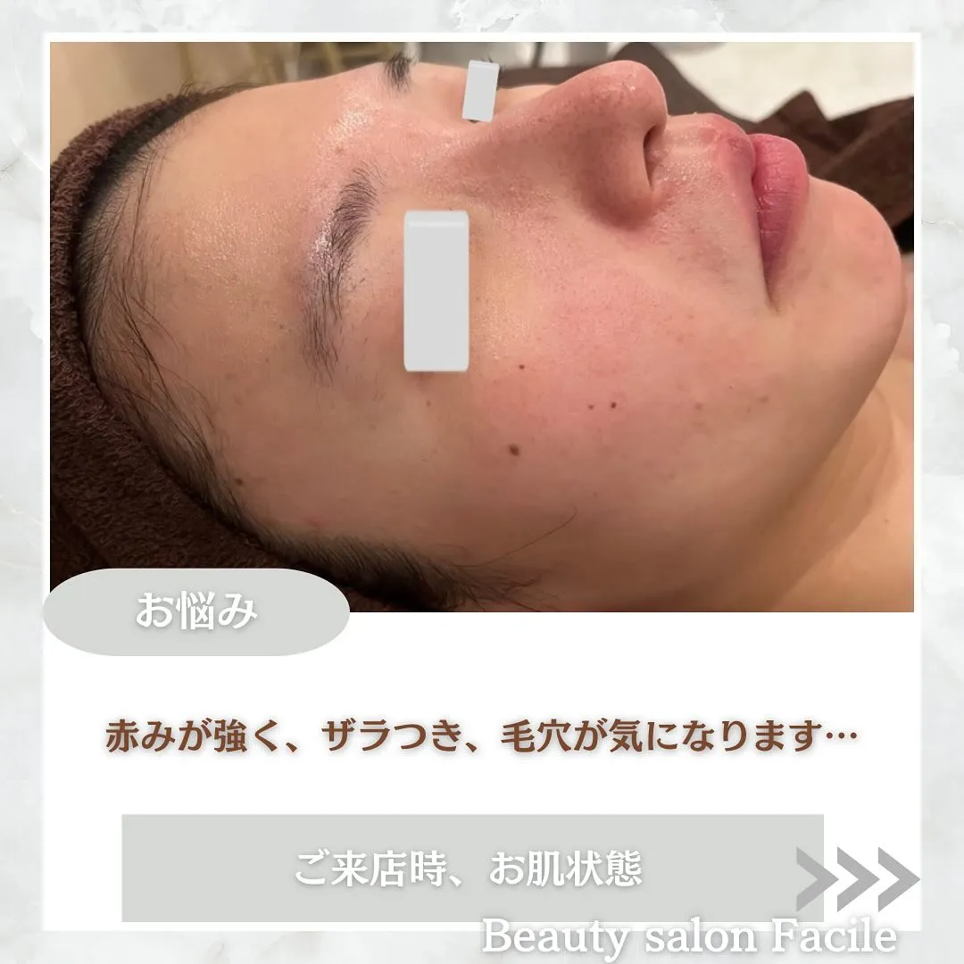 太田市にある頑固なニキビ専門店です✨️