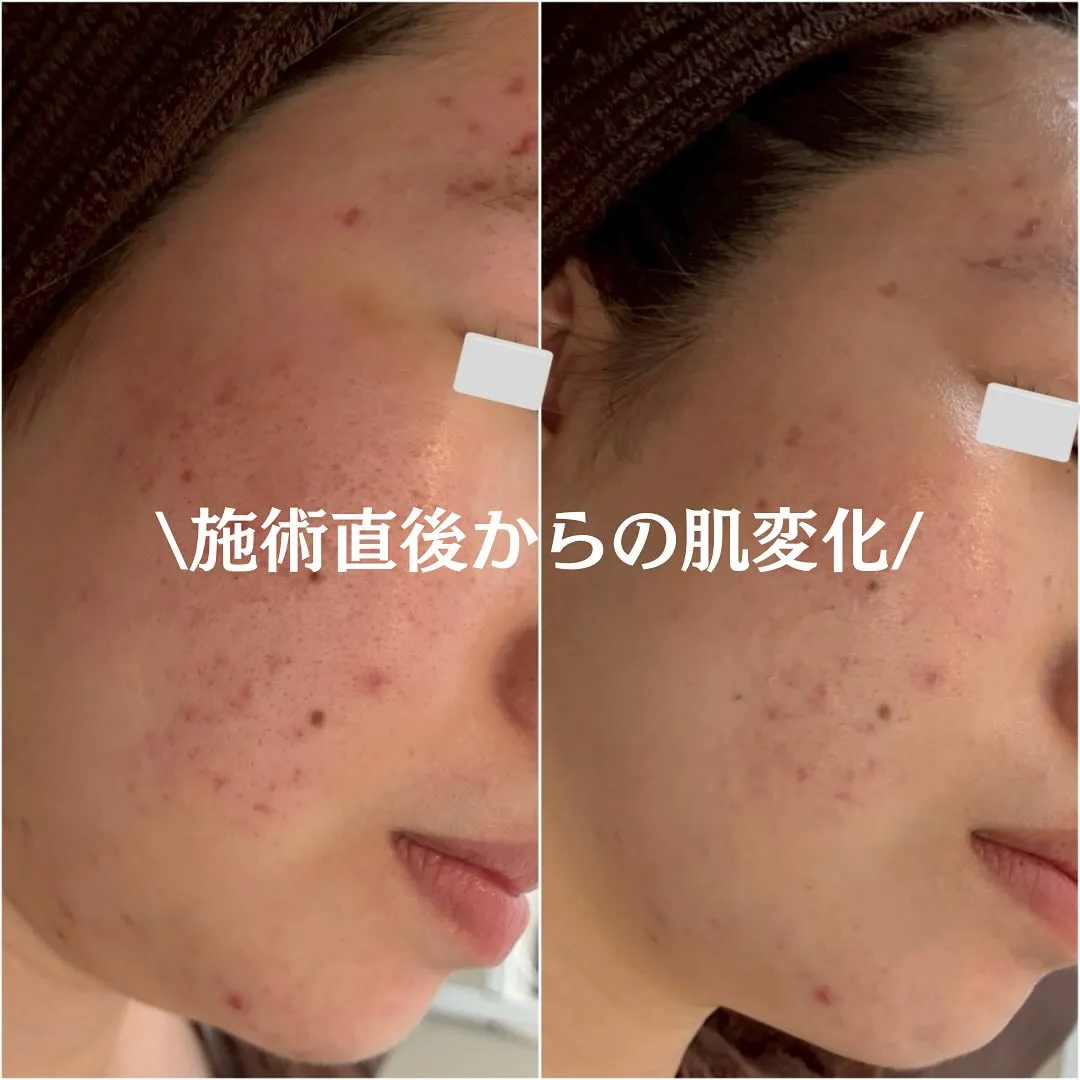 太田市にある頑固なニキビ専門店です✨️