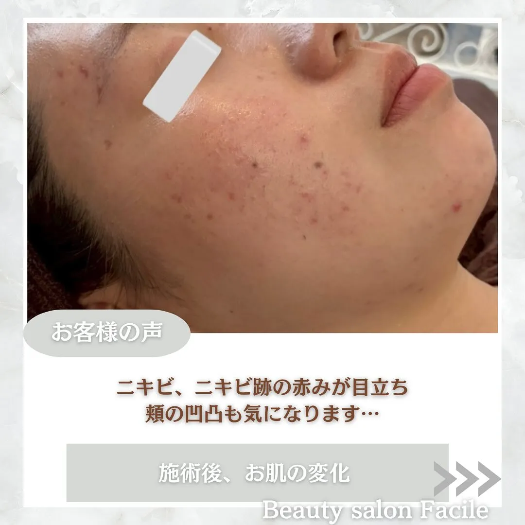 太田市にある頑固なニキビ専門店です✨️