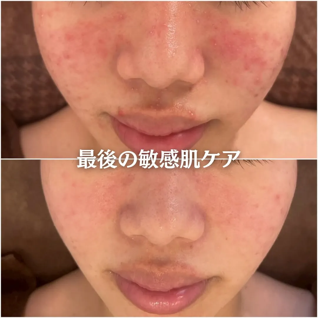 太田市にある頑固なニキビ専門店です✨️