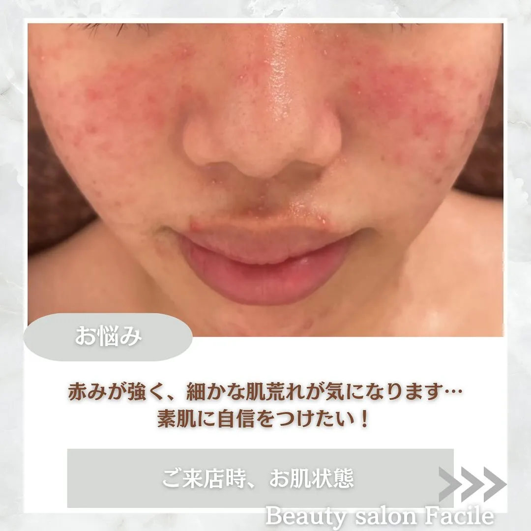 太田市にある頑固なニキビ専門店です✨️