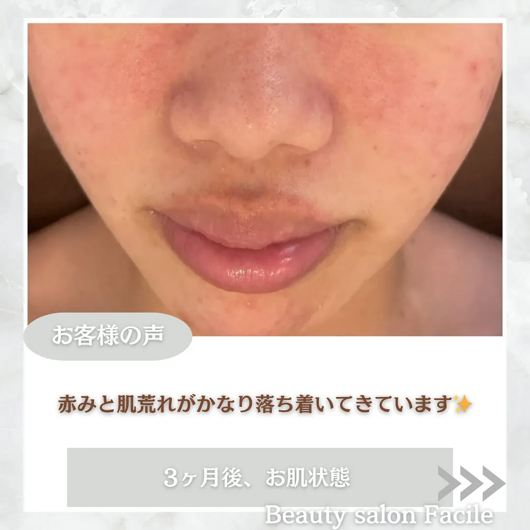 太田市にある頑固なニキビ専門店です✨️