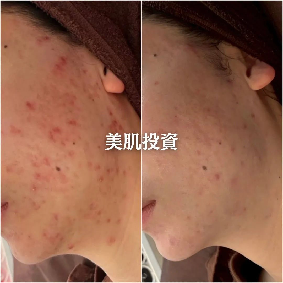 太田市にある頑固なニキビ専門店です✨️