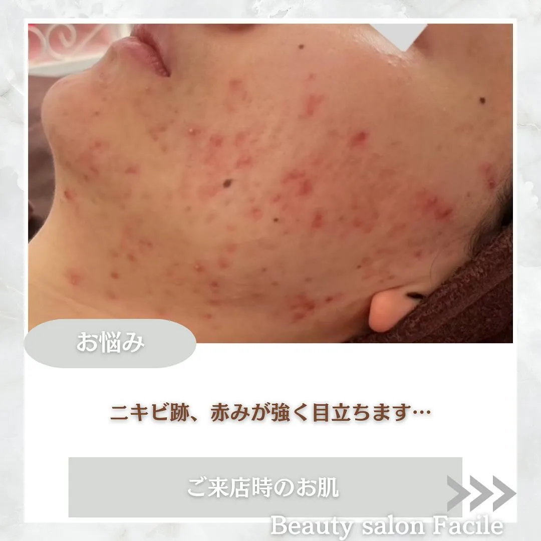 太田市にある頑固なニキビ専門店です✨️