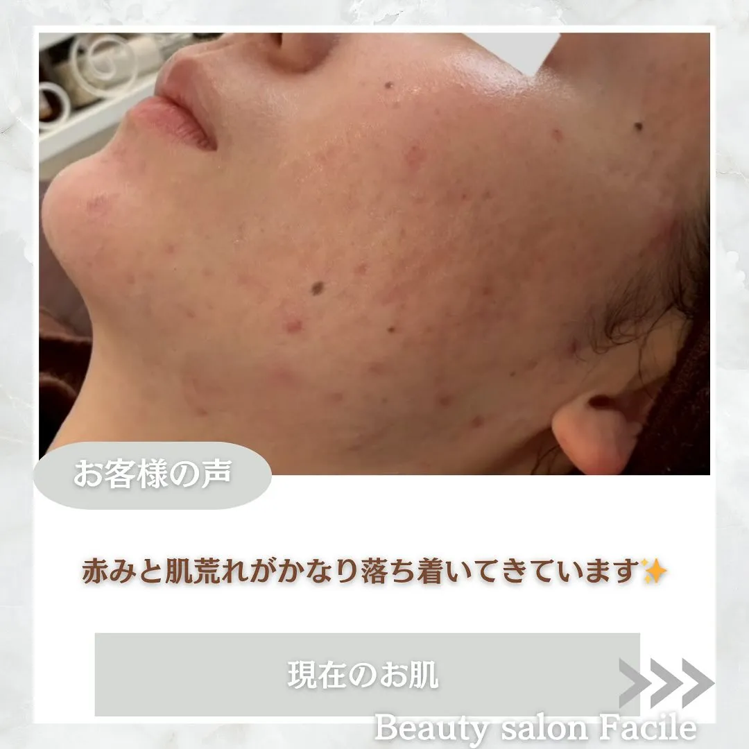 太田市にある頑固なニキビ専門店です✨️