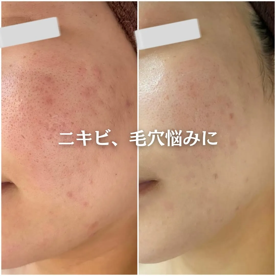 太田市にある頑固なニキビ専門店です✨️