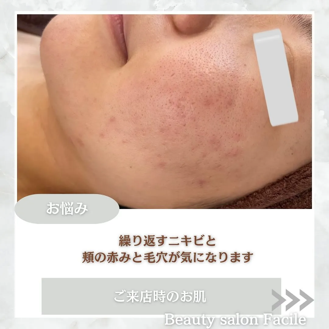 太田市にある頑固なニキビ専門店です✨️