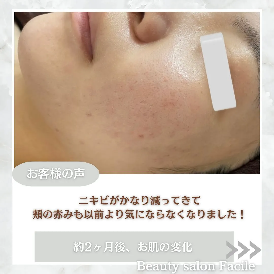 太田市にある頑固なニキビ専門店です✨️