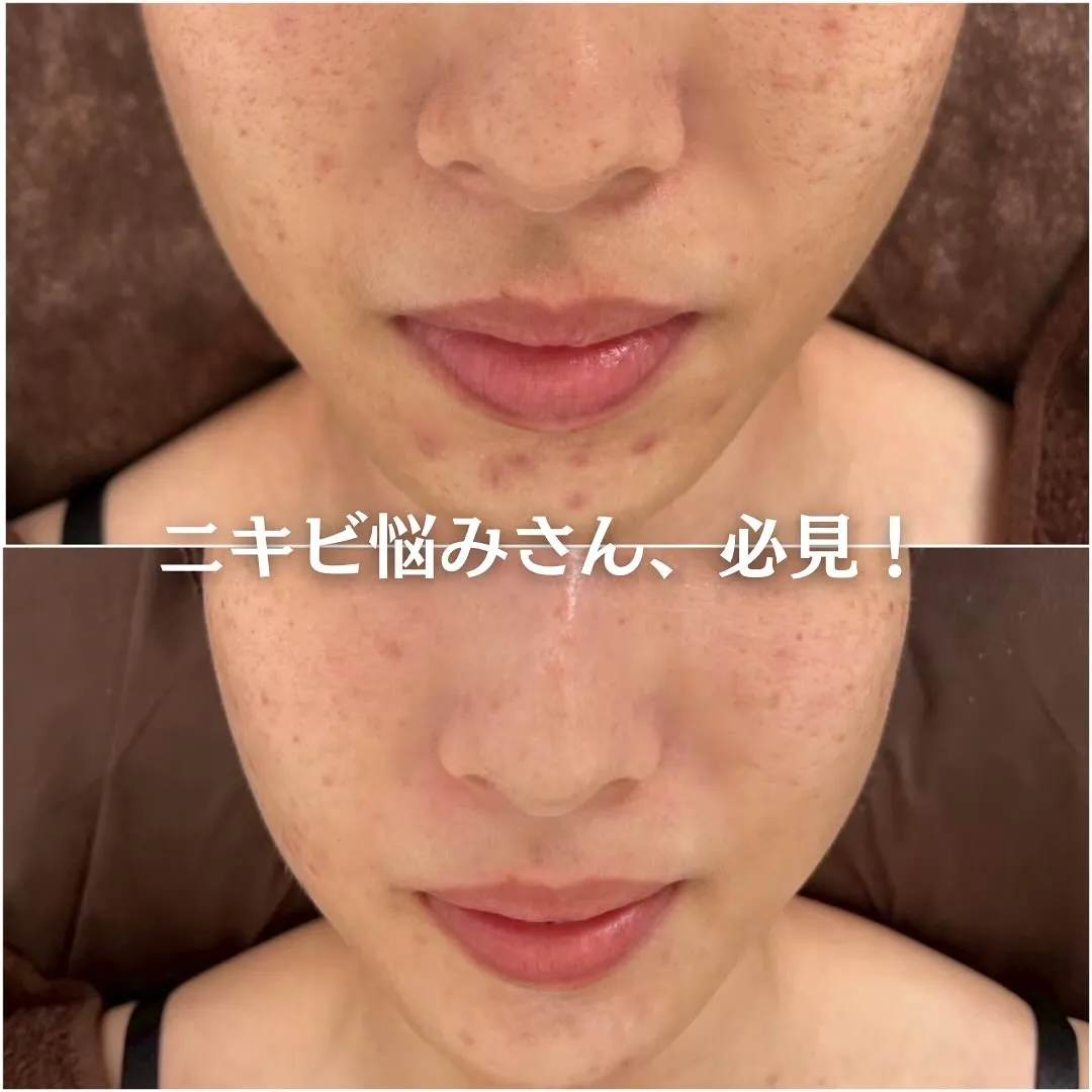 太田市にある頑固なニキビ専門店です✨️