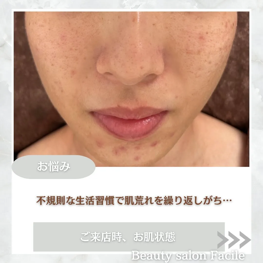 太田市にある頑固なニキビ専門店です✨️