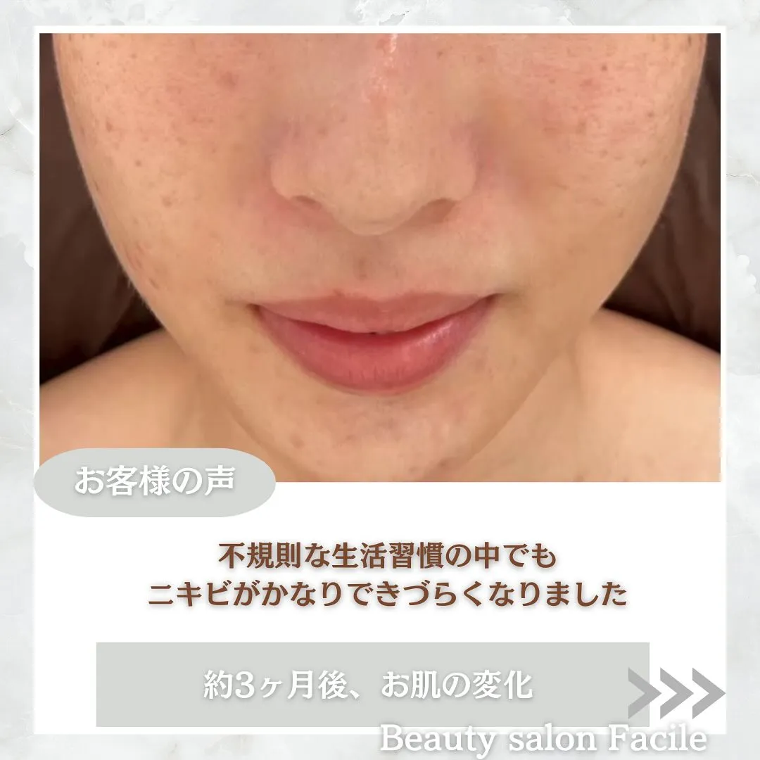 太田市にある頑固なニキビ専門店です✨️