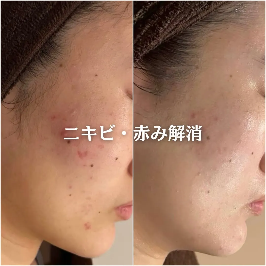 太田市にある頑固なニキビ専門店です✨️