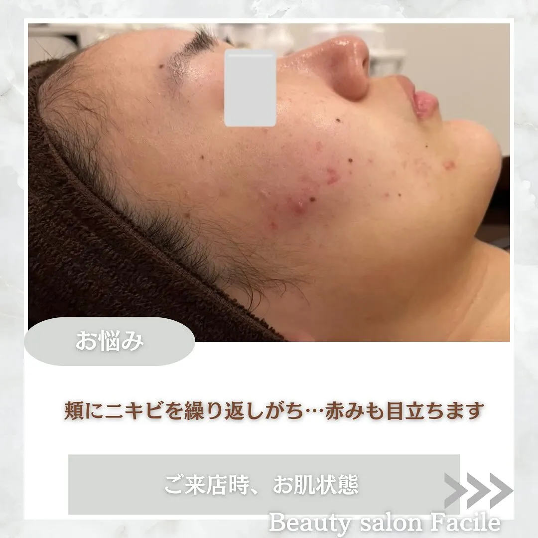 太田市にある頑固なニキビ専門店です✨️