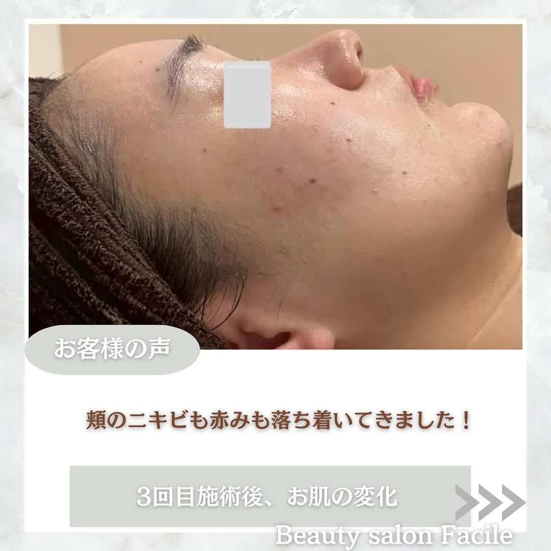 太田市にある頑固なニキビ専門店です✨️